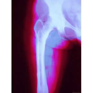  Leg Bone Colorized Xray Abdomen Pelvis Femur Joint 